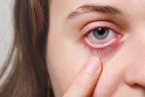 dry eye syndrome