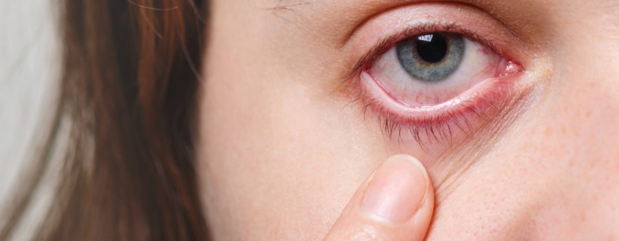 dry eye syndrome