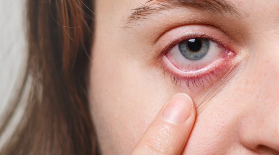 dry eye syndrome