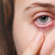Is It Winter Dryness or Chronic Dry Eye?