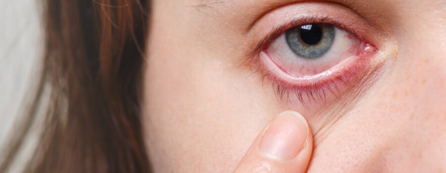 chronic dry eye vs winter dry eye